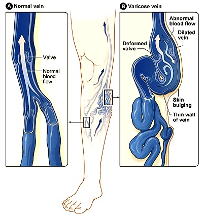 Normal Vein and Varicose Vein